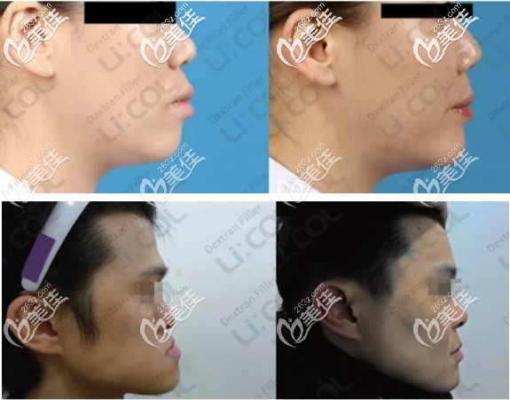 凸嘴地包天的人注射葡聚糖前后對(duì)比照片 凸嘴地包天的人注射葡聚糖前后對(duì)比照片