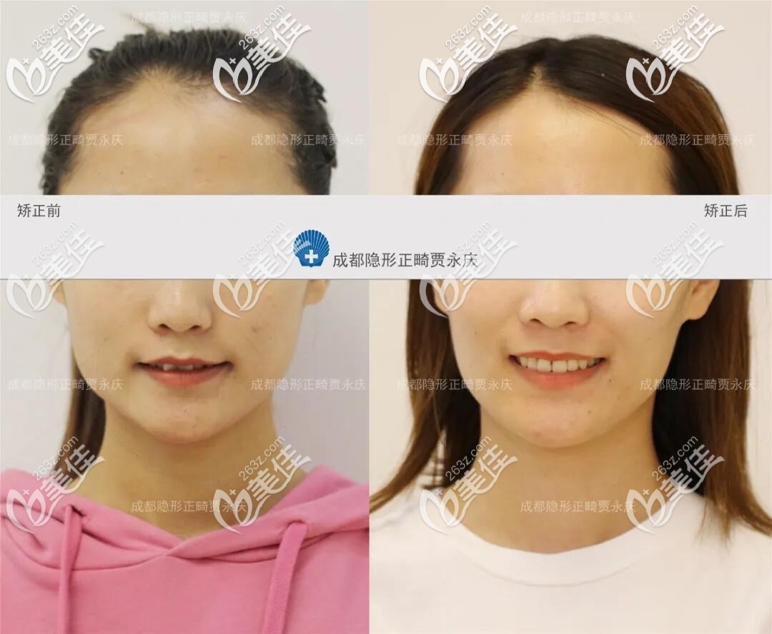 深覆合矯正臉型變化圖 深覆合矯正臉型變化圖