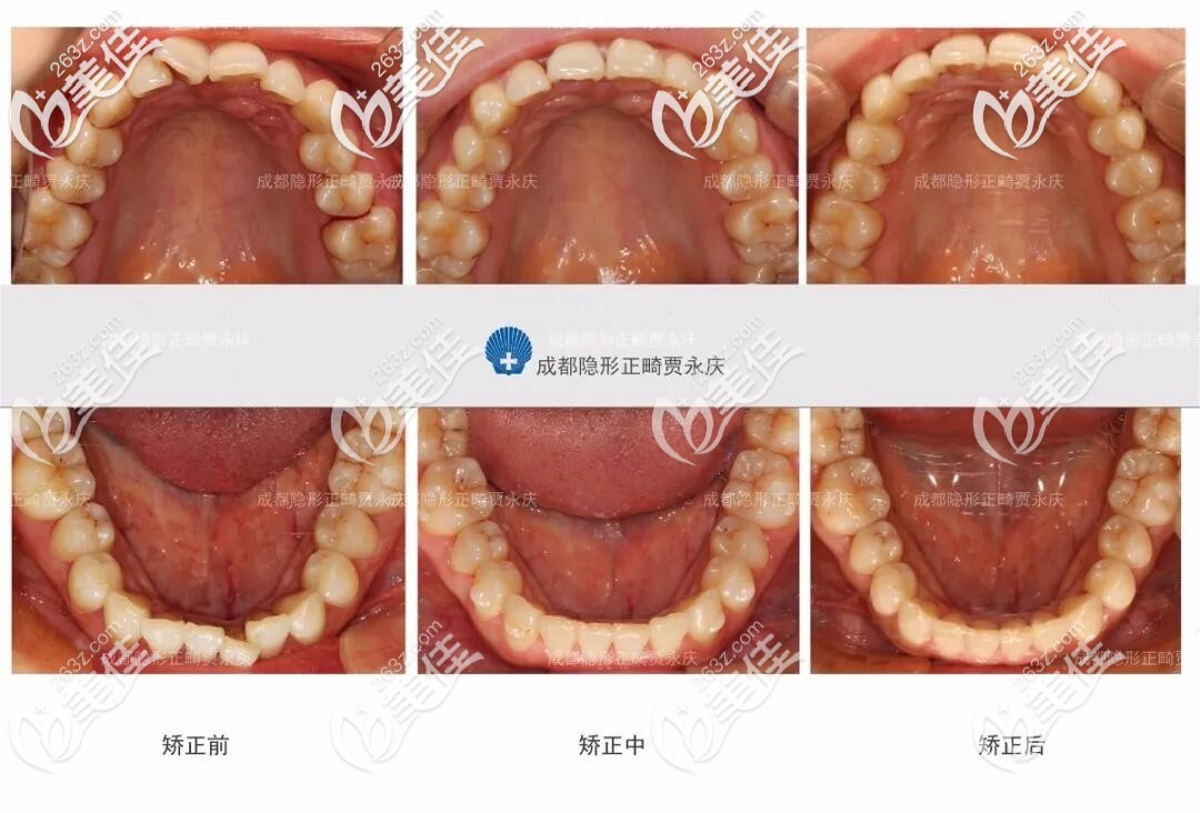 隱形矯正推磨牙后移 隱形矯正推磨牙后移