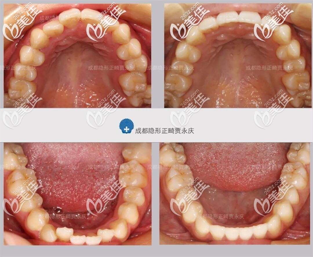 牙齒不齊口腔對(duì)比照 牙齒不齊口腔對(duì)比照
