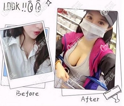 花一萬多做藍貝假體隆胸后我覺得術(shù)后效果和手感一點不比進口曼托差