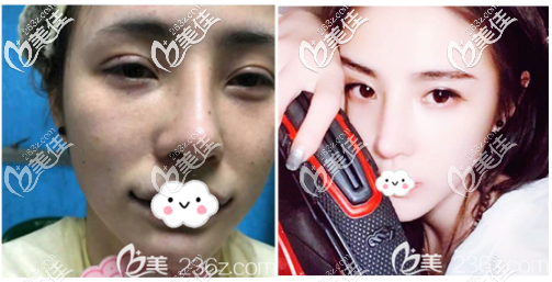 深圳潤(rùn)澤瑞尼絲劉庚自體脂填充案例