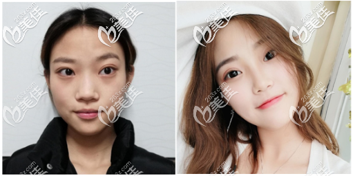 深圳潤(rùn)澤瑞尼絲李忠醫(yī)生肋軟骨隆鼻案例