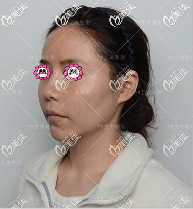 做一針降低顴弓當(dāng)天術(shù)前留照