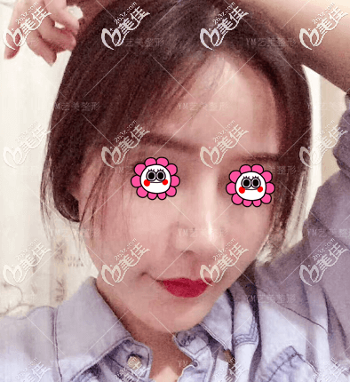 一針降顴弓有用嗎？我做不開(kāi)刀降低顴弓一個(gè)月效果借鑒