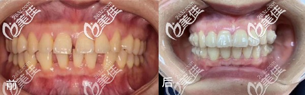 武漢優(yōu)益佳口腔牙齒矯正真人案例 武漢優(yōu)益佳口腔牙齒矯正真人案例