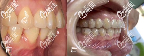 武漢優(yōu)益佳口腔隱形牙齒矯正案例 武漢優(yōu)益佳口腔隱形牙齒矯正案例