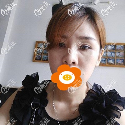 這是做祛眼袋手術(shù)前的我 這是做祛眼袋手術(shù)前的我