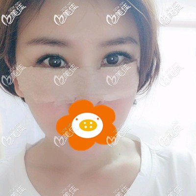 剛做完內(nèi)切祛眼袋手術(shù)的我 剛做完內(nèi)切祛眼袋手術(shù)的我