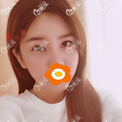 我的淚溝型眼袋在福州格萊美做了內(nèi)切祛眼袋手術(shù)，今天分享恢復(fù)過(guò)程圖片