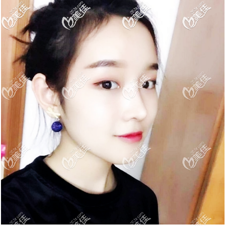 美萊鼻綜合怎么樣？分享我在廣州美萊做鼻綜合親身經(jīng)歷