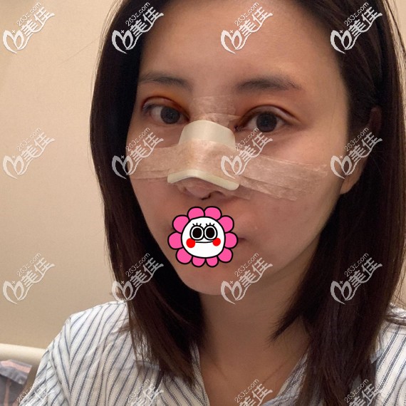 雙眼皮隆鼻術(shù)后即刻