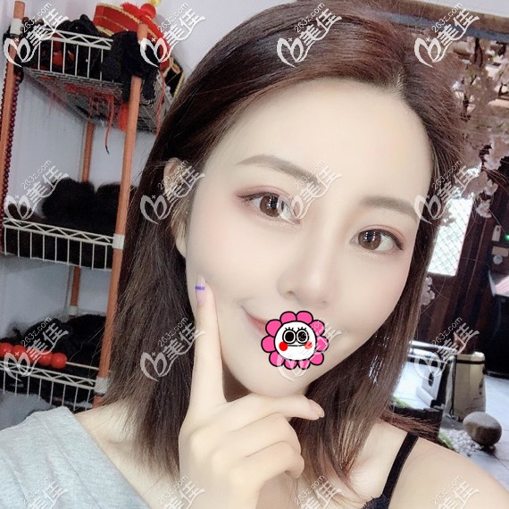 不用考慮隆鼻和雙眼皮先做哪個，來看看一起做的改善有多大