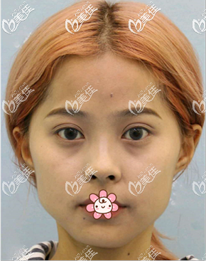 術(shù)前的我 術(shù)前的我