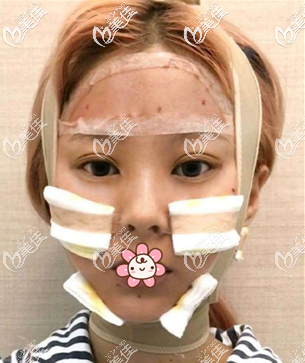 我在泰國(guó)曼谷雨季做完磨骨手術(shù)六天了 我在泰國(guó)曼谷雨季做完磨骨手術(shù)六天了