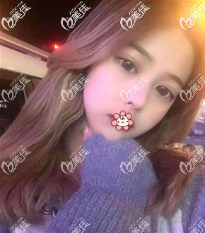 兩個(gè)月后臉小了好多 兩個(gè)月后臉小了好多