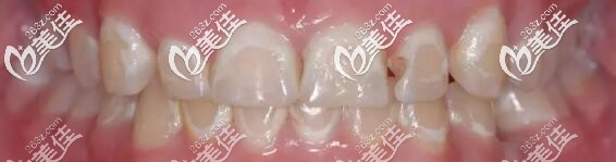 金屬托槽矯正牙齒出現(xiàn)白斑 金屬托槽矯正牙齒出現(xiàn)白斑