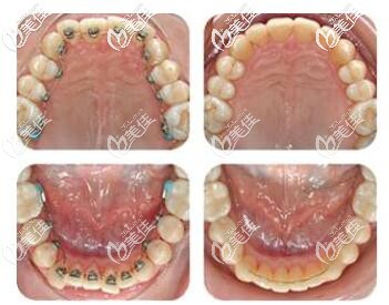 舌側隱形矯正 舌側隱形矯正