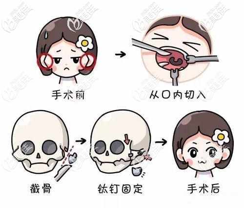 顴骨內(nèi)推手術(shù)過程