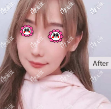 我做面部埋線提升10天后沒有出現(xiàn)臉部凹陷的情況而且到現(xiàn)在皮膚都挺緊致