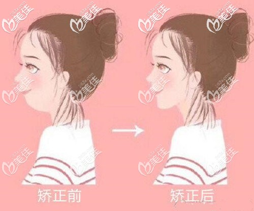 自述:我在常德私立口腔醫(yī)院戴隱適美牙套矯正齙牙的經(jīng)歷,想知道效果怎么樣的進(jìn)來看