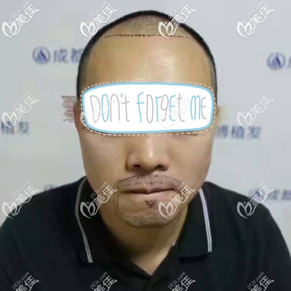 醫(yī)生設計的胡須及發(fā)際線形狀