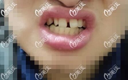 南昌維樂口腔隱適美隱形矯正真人實例 南昌維樂口腔隱適美隱形矯正真人實例