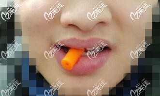 隱形矯正咬膠 隱形矯正咬膠