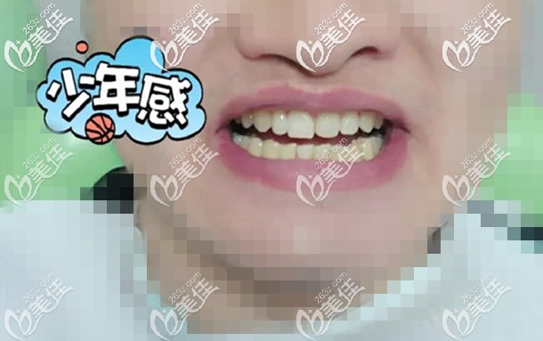 門(mén)牙縫隙+偏頜南昌男青年分享20副牙套效果,雖然隱適美隱形矯正價(jià)格貴點(diǎn)但是還是值得的