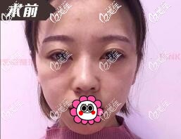 做自體脂肪面部填充前 做自體脂肪面部填充前