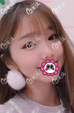 花三萬多做了自體脂肪面部填充，效果自然還變年輕了所以給大家分享一下我的經(jīng)歷