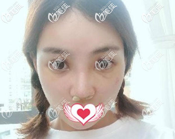 鼻修復(fù)手術(shù)第7天拆線微腫