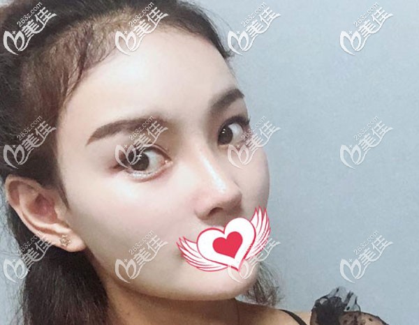 二次鼻修復(fù)2個月鼻子看起來很自然