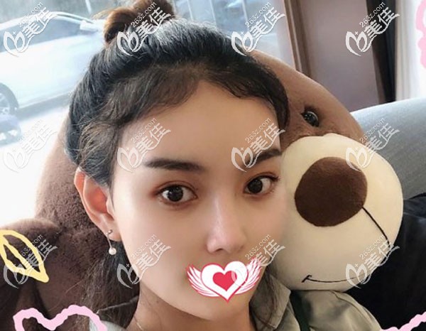 硅膠隆鼻失敗了鼻頭向右歪，耳軟骨鼻綜合二次修復(fù)后效果還不錯(cuò)