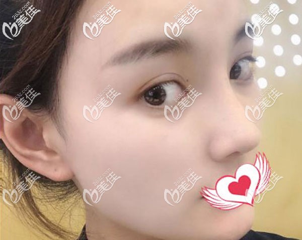 耳軟骨鼻修復(fù)一個月基本已經(jīng)定型