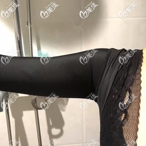 剛做完胳膊吸脂術(shù)后穿束身衣
