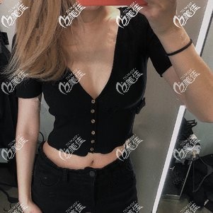 吸脂瘦手臂術(shù)后1個(gè)月胳膊變細(xì)