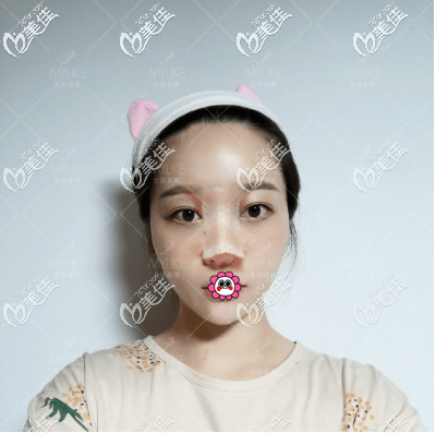 <!--<i data=20240703-sp></i>-->給我做肋軟骨隆鼻第3天