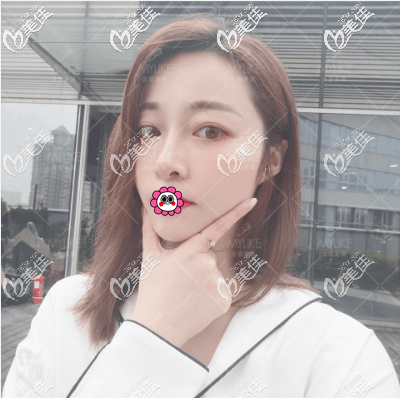 北京美萊鼻子做得怎么樣?她說(shuō)我花六萬(wàn)多做肋軟骨隆鼻好漂亮