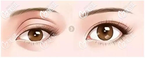 眼窩凹陷的改善效果