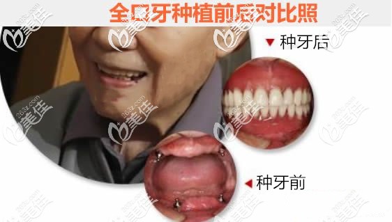 我30歲開始戴活動(dòng)假牙,終于在大同私立口腔醫(yī)院換上了allon4全口即刻種植牙