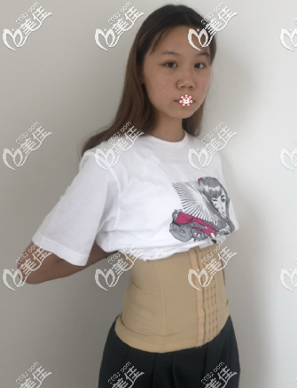 我在貴陽美萊做完腰腹吸脂剛一個(gè)月