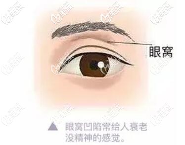 眼窩凹陷顯老 眼窩凹陷顯老