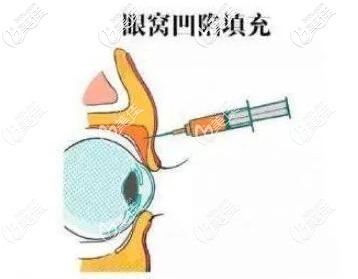 為什么不建議用玻尿酸填充眼窩 為什么不建議用玻尿酸填充眼窩