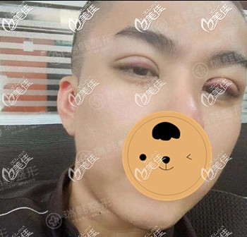 男生割完雙眼皮術后效果圖