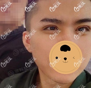 男生割雙眼皮術后5天恢復效果照