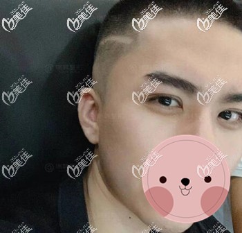 男生割雙眼皮術后30天恢復圖