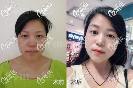 長沙雅美第五代熱瑪吉除皺抗衰真人前后對比效果圖