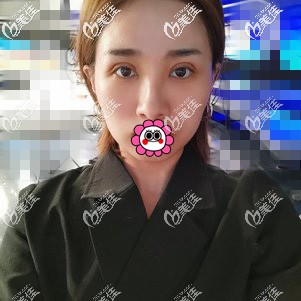 眼修復恢復4天已經(jīng)消腫 眼修復恢復4天已經(jīng)消腫