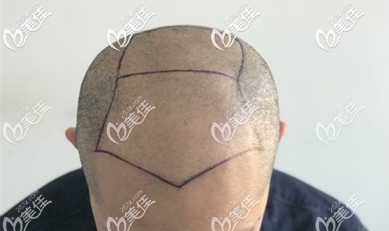 5級(jí)脫發(fā)種植4000毛囊單位效果示意圖